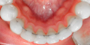 Ortodoncia Invisalign - Retenedores fijos