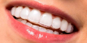 Ortodoncia Invisalign - Retenedores removibles